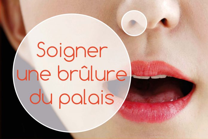Comment traiter une brulure du palais